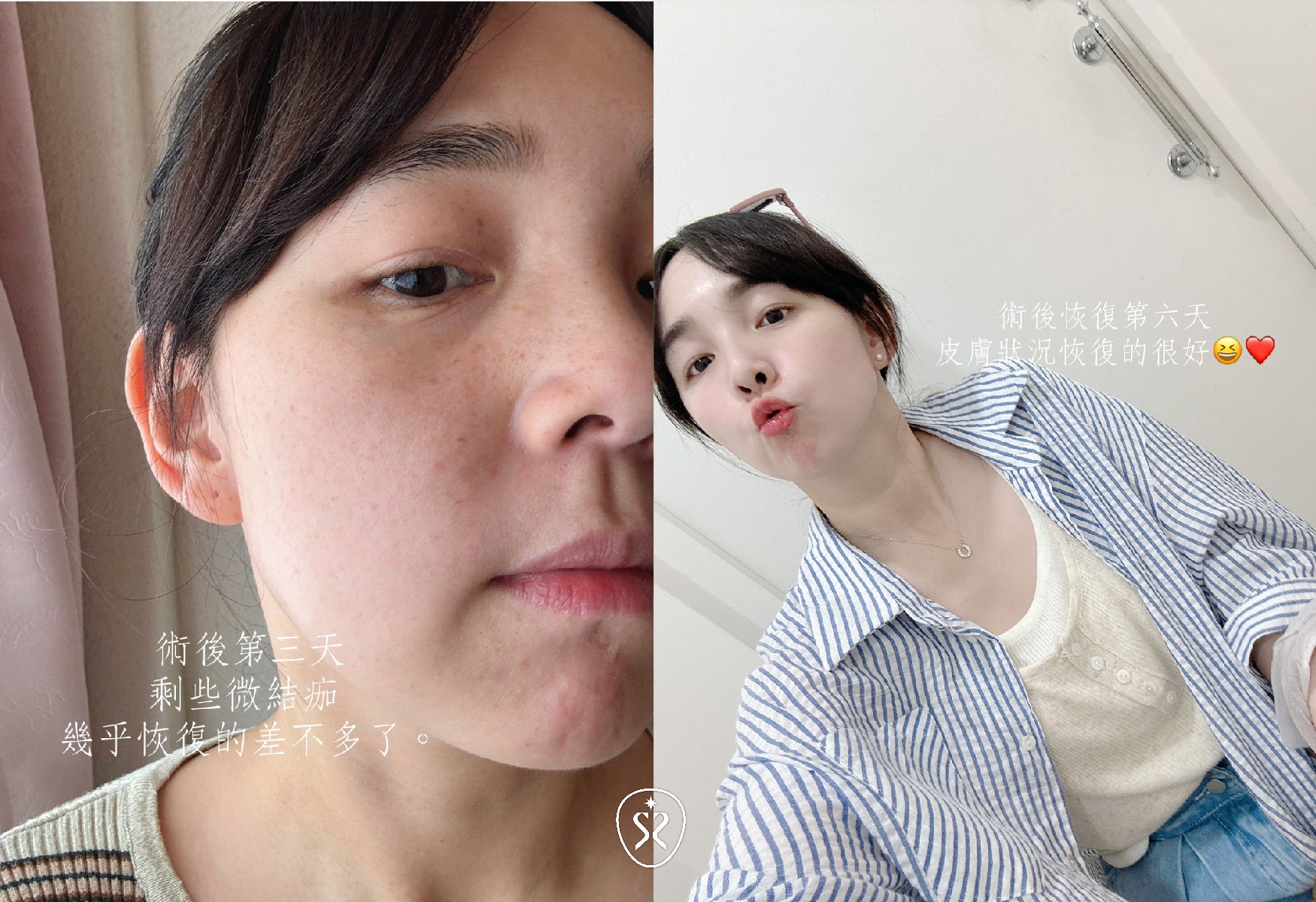 【水光注射】